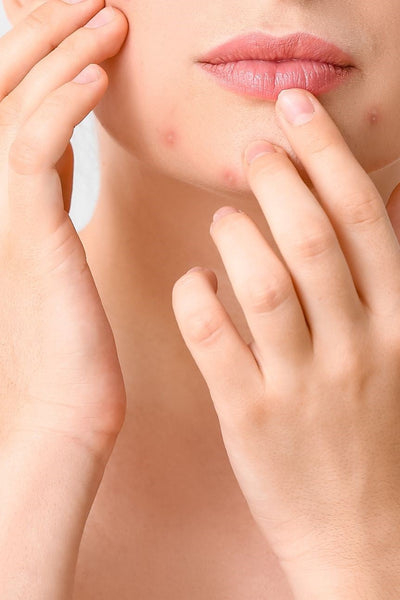 Wat is hormonale acne en wat kun je eraan doen?